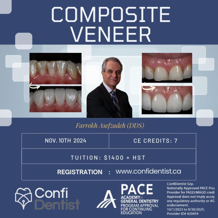 Composite Veneers
